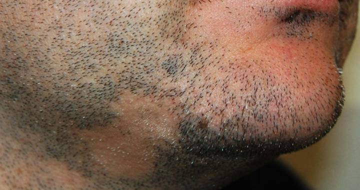 alopecia-barba
