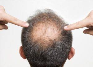 consejos-para-prevenir-la-alopecia