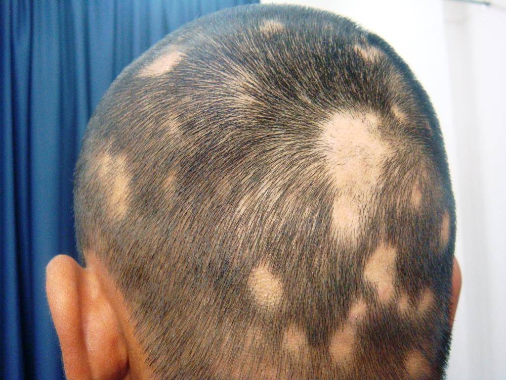 alopecia-areata