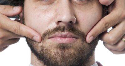 Alopecia Areata en barba