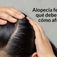 alopecia en mujeres